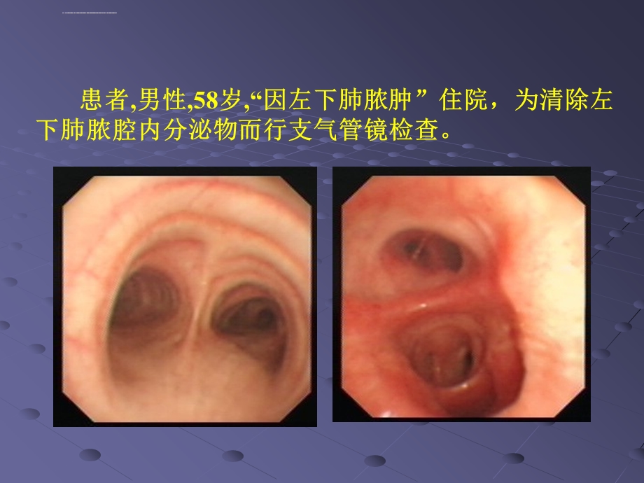 支气管镜诊疗相关大咯血的预防与救治ppt课件.ppt_第3页