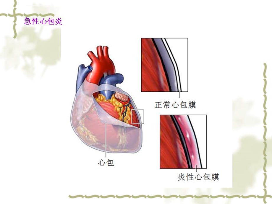 急性心包炎心电图表现ppt课件.ppt_第3页