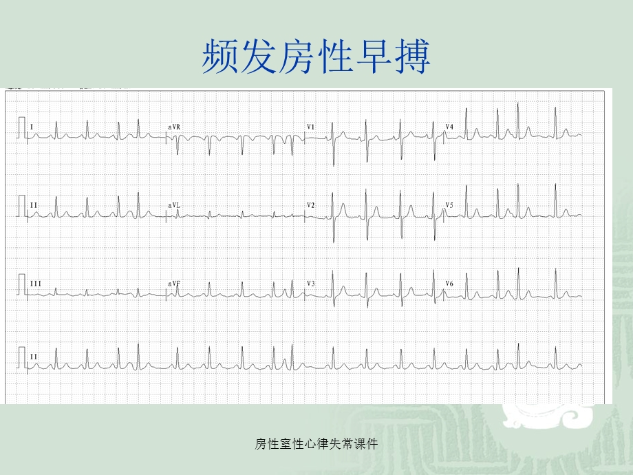 房性室性心律失常课件.ppt_第3页