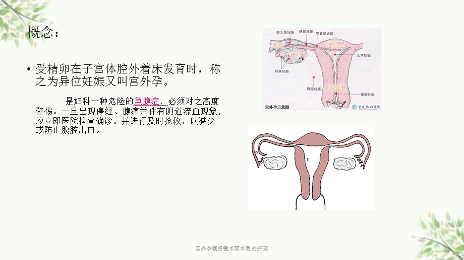 宫外孕腹腔镜术前术后的护理课件.ppt_第2页