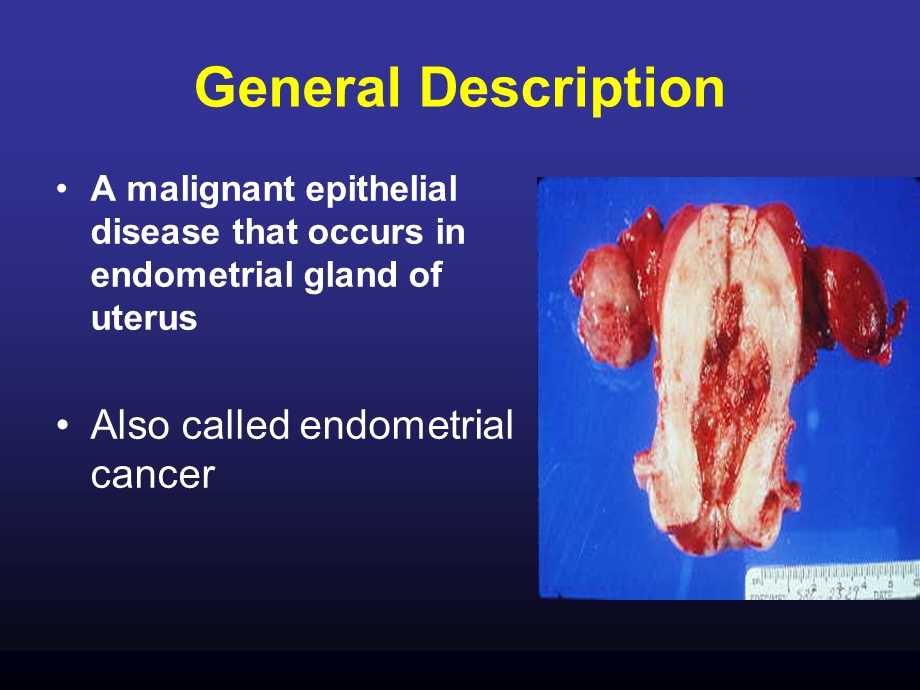 子宫癌(UterineCancer)妇科八年制教学课件.ppt_第3页