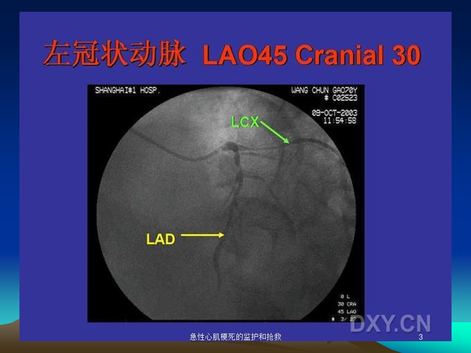 急性心肌梗死的监护和抢救培训课件.ppt_第3页