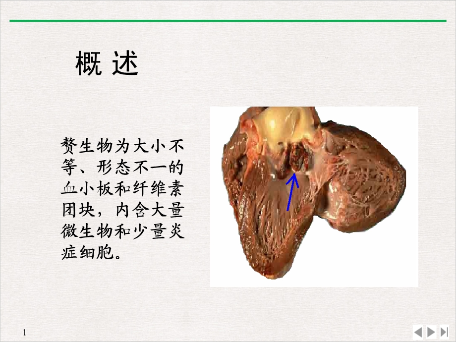 感染性心内膜炎学时课件.ppt_第3页