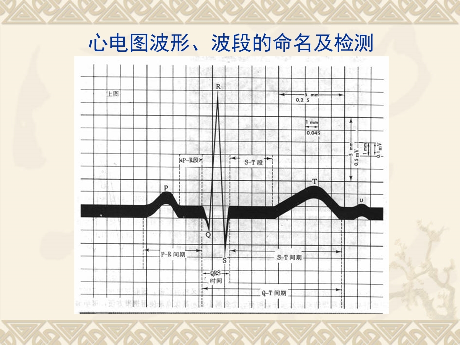 快速分析心电图ppt课件.ppt_第3页