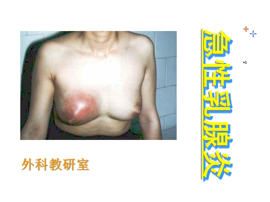 急性乳腺炎外科治疗医学课件.ppt_第1页