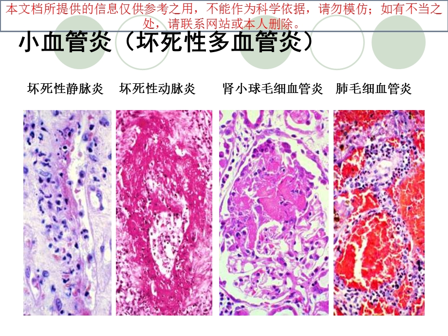 抗中性粒细胞胞浆抗体相关性血管炎培训课件.ppt_第3页