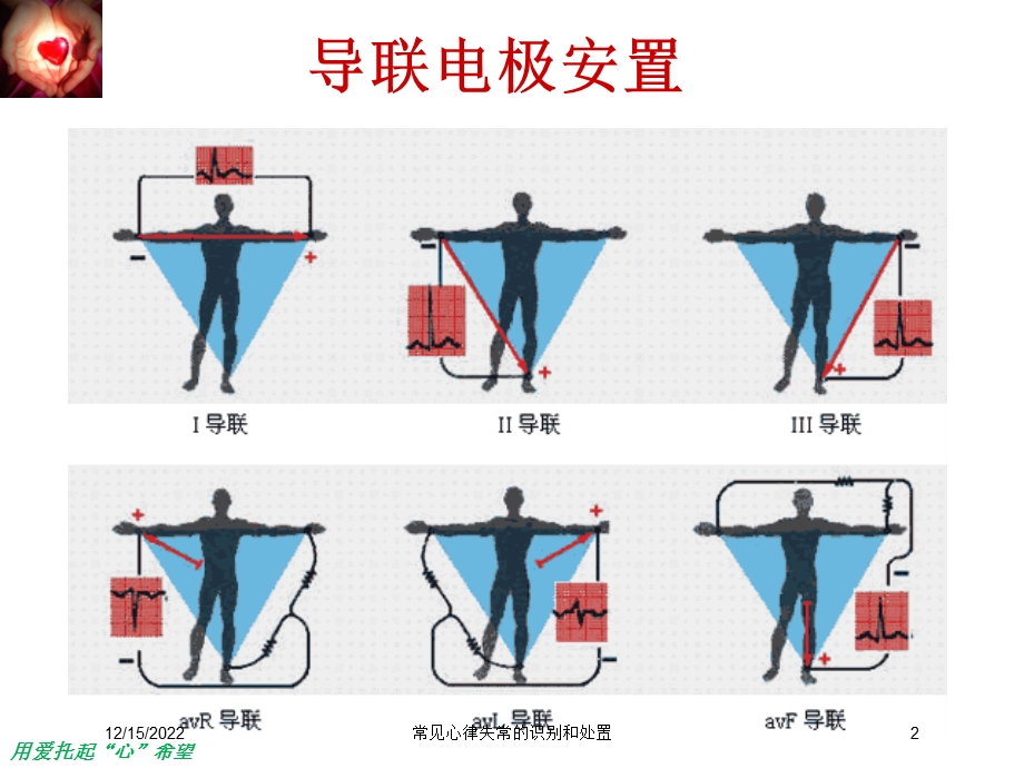 常见心律失常的识别和处置课件.ppt_第2页