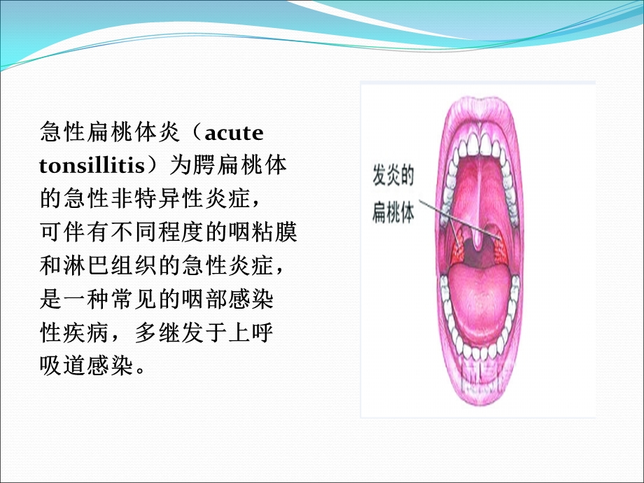 急性扁桃体炎病人护理课件.ppt_第2页