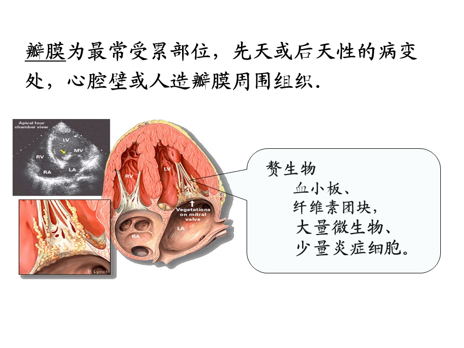 感染性心内膜炎护理查房(共26张)课件.pptx_第3页