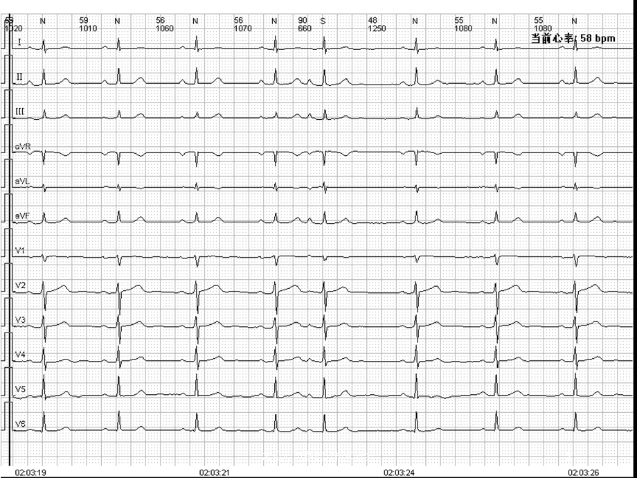 常见心电图的分析和诊疗培训课件.ppt_第2页
