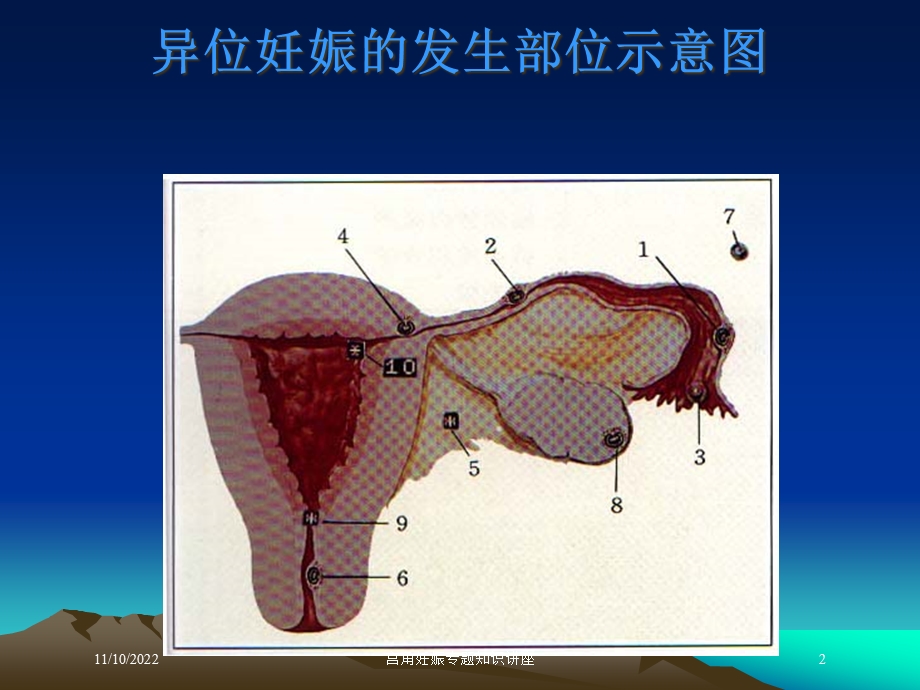 宫角妊娠专题知识讲座培训课件.ppt_第2页