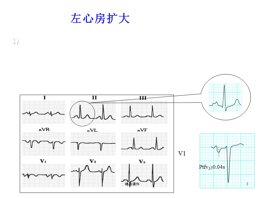 常见异常心电图医学课件.ppt_第3页