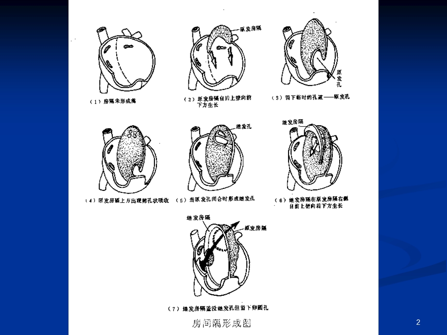 房间隔缺损和动脉导管未闭培训课件.ppt_第2页