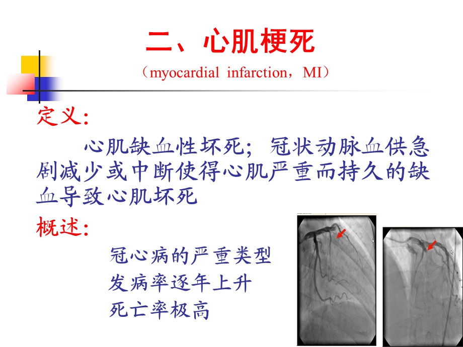 心肌梗死课件精.ppt_第2页