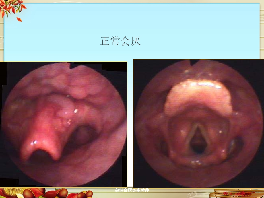 急性会厌炎课件.ppt_第3页