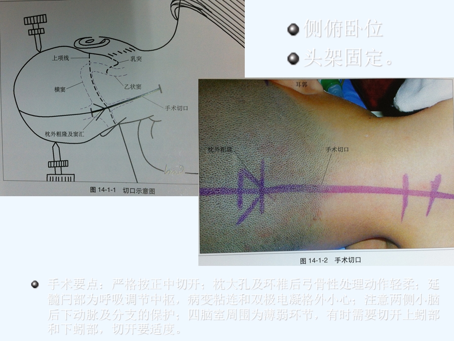 枕下后正中入路解剖ppt课件.ppt_第3页