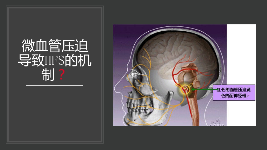 术中电生理监测在面肌痉挛微血管减压术中的应用ppt课件.pptx_第3页