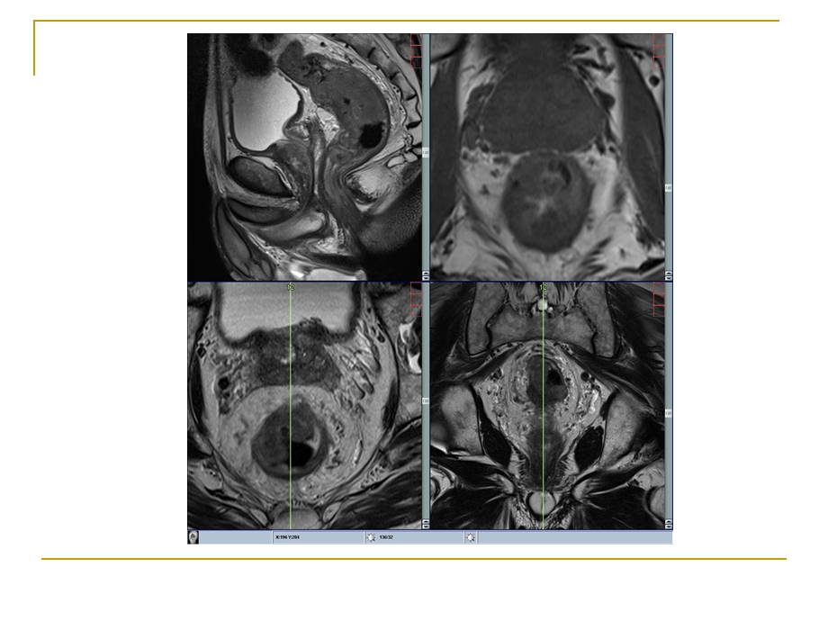 直肠癌MRI诊断ppt课件.pptx_第3页