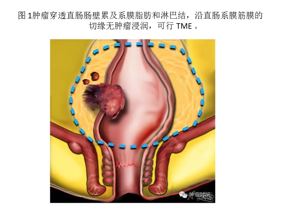 直肠癌诊疗图解ppt课件.pptx_第3页