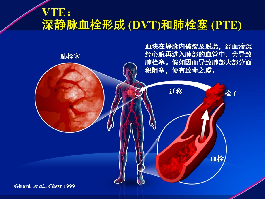 深静脉血栓防治解读ppt课件.ppt_第3页