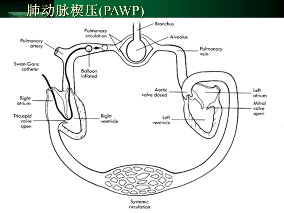 漂浮导管的临床应用ppt课件.ppt_第2页