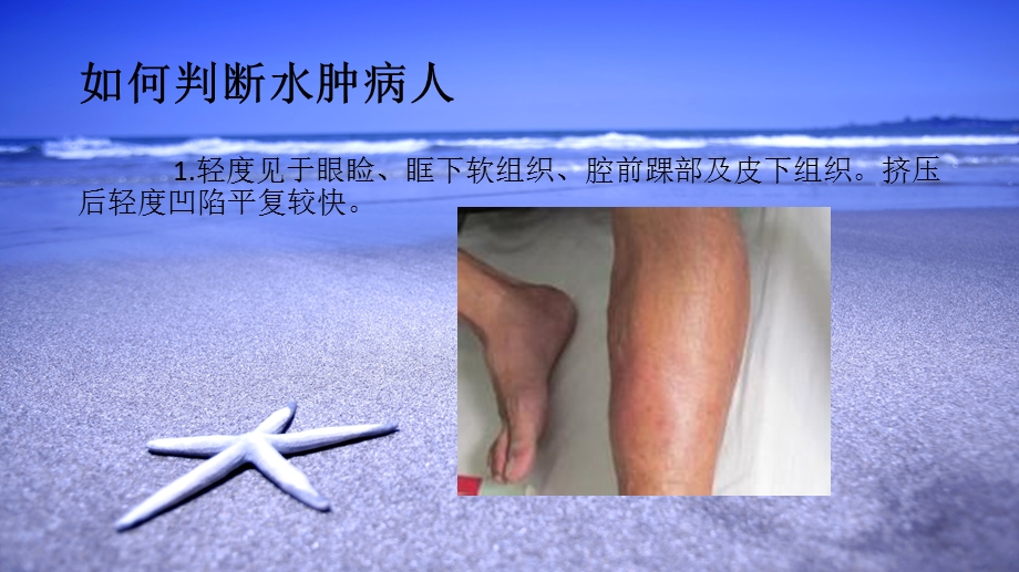 水肿病人的护理ppt课件.ppt_第3页