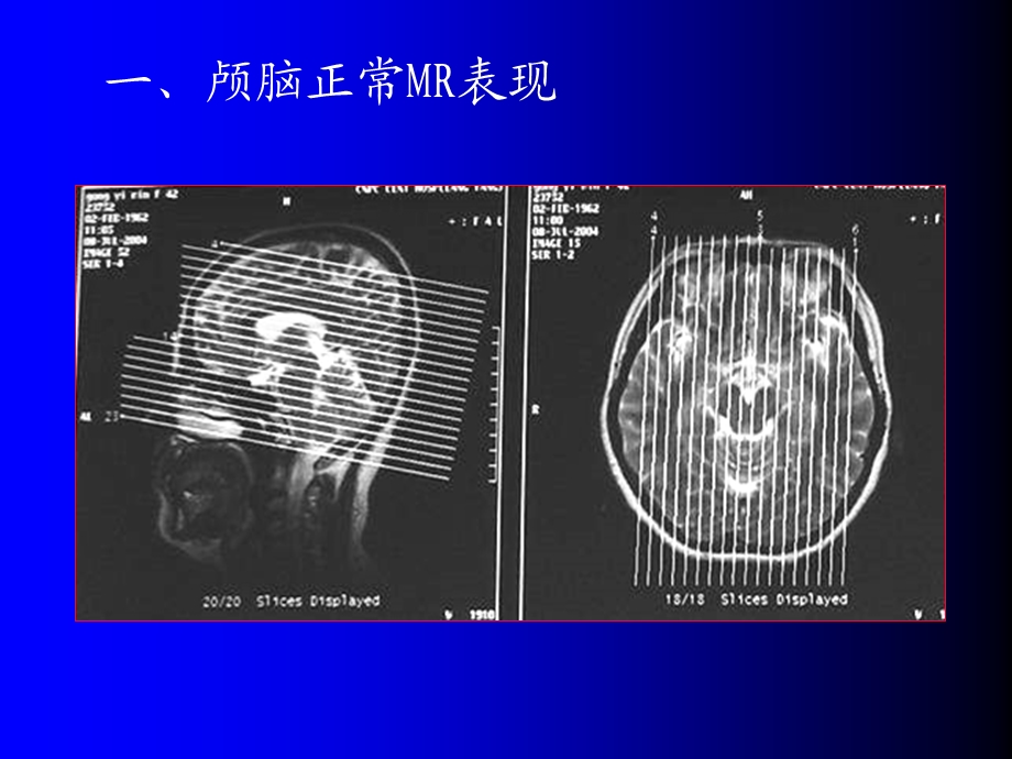 磁共振成像诊断(MRI)脑部疾病ppt课件.ppt_第3页