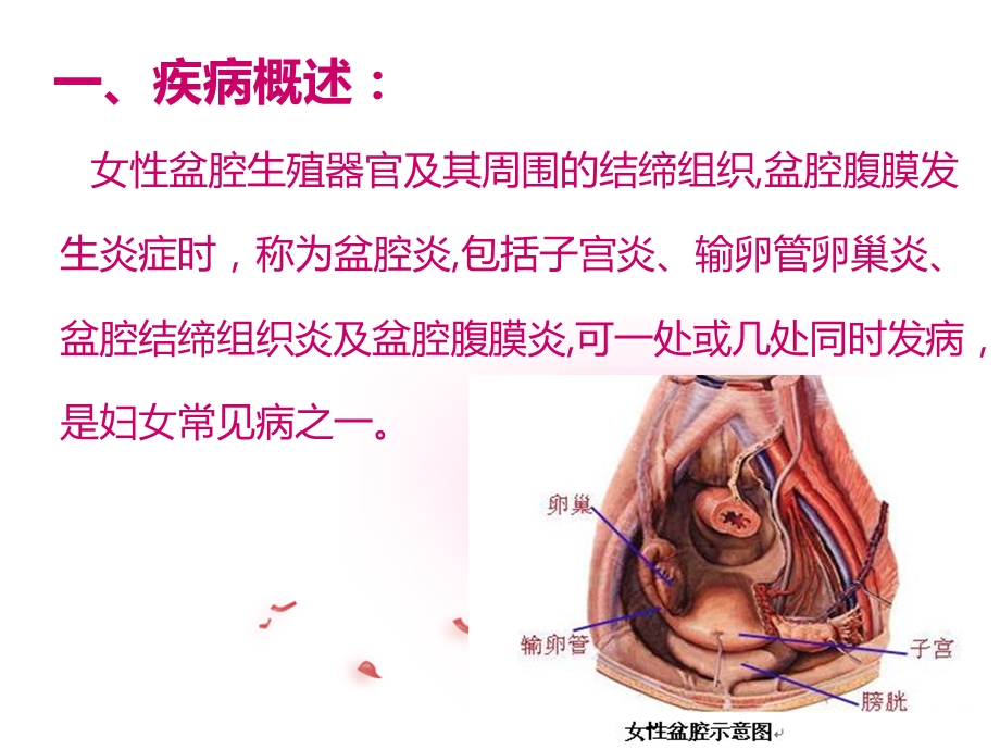 盆腔炎护理ppt课件.ppt_第3页