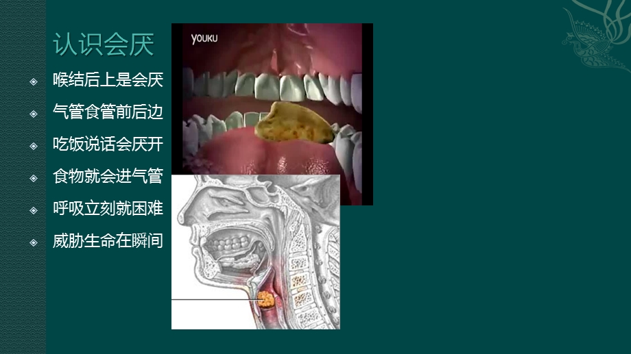 气道异物梗阻的急救处理ppt课件.ppt_第3页