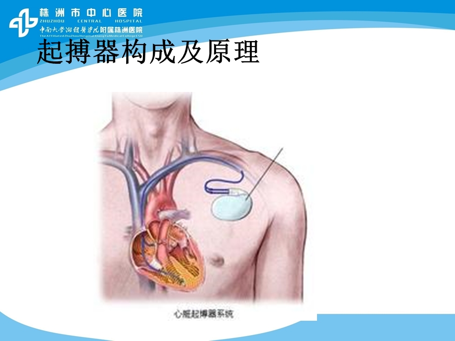 永久型起搏器术后运动康复ppt课件.ppt_第3页