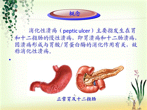 消化系统消化性溃疡护理业务学习ppt课件.ppt