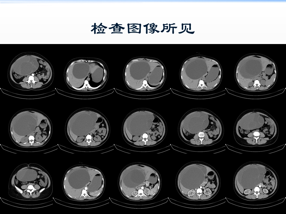 疑难病例讨论——肝内胆管囊腺瘤上课讲义ppt课件.ppt_第3页