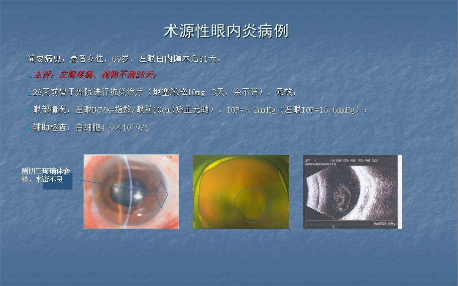 白内障眼内炎医学ppt课件.ppt_第2页