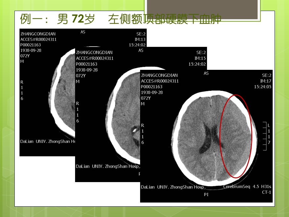 等密度硬膜下血肿的CT征象ppt课件.pptx_第3页