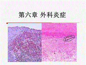 第六章外科炎症分解ppt课件.ppt