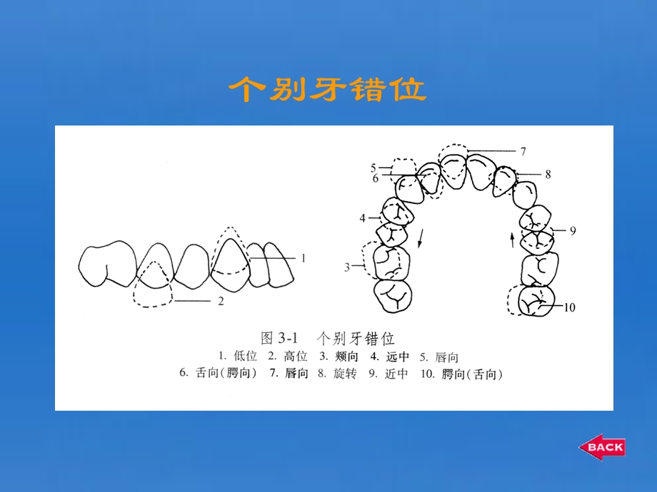 第3章错颌畸形的临床表现及分类ppt课件.ppt_第3页