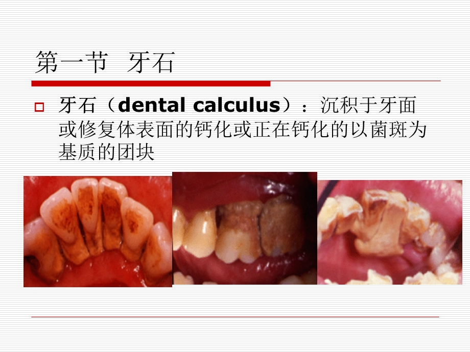 第六章牙周病的局部促进因素ppt课件.ppt_第2页