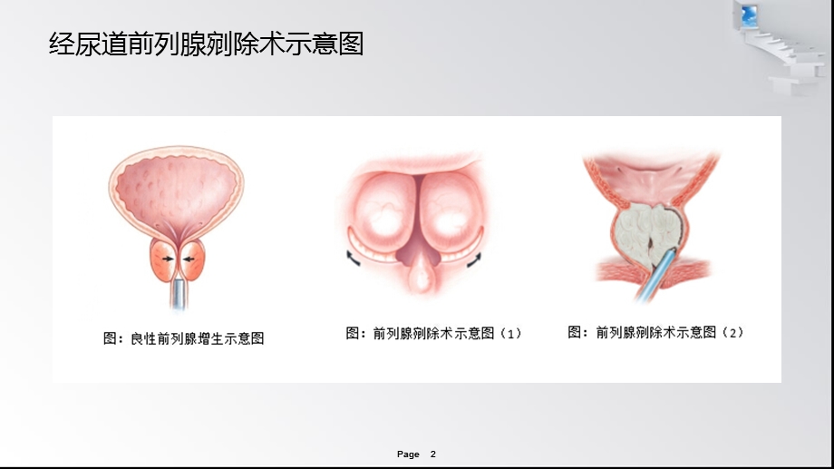 经尿道前列腺剜除术笔记ppt课件.pptx_第2页