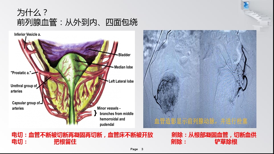 经尿道前列腺剜除术笔记ppt课件.pptx_第3页