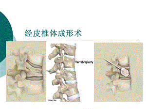 经皮椎体成形术ppt课件.ppt