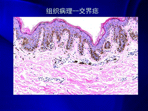 皮肤肿瘤良性皮肤肿瘤陈浩ppt课件.ppt