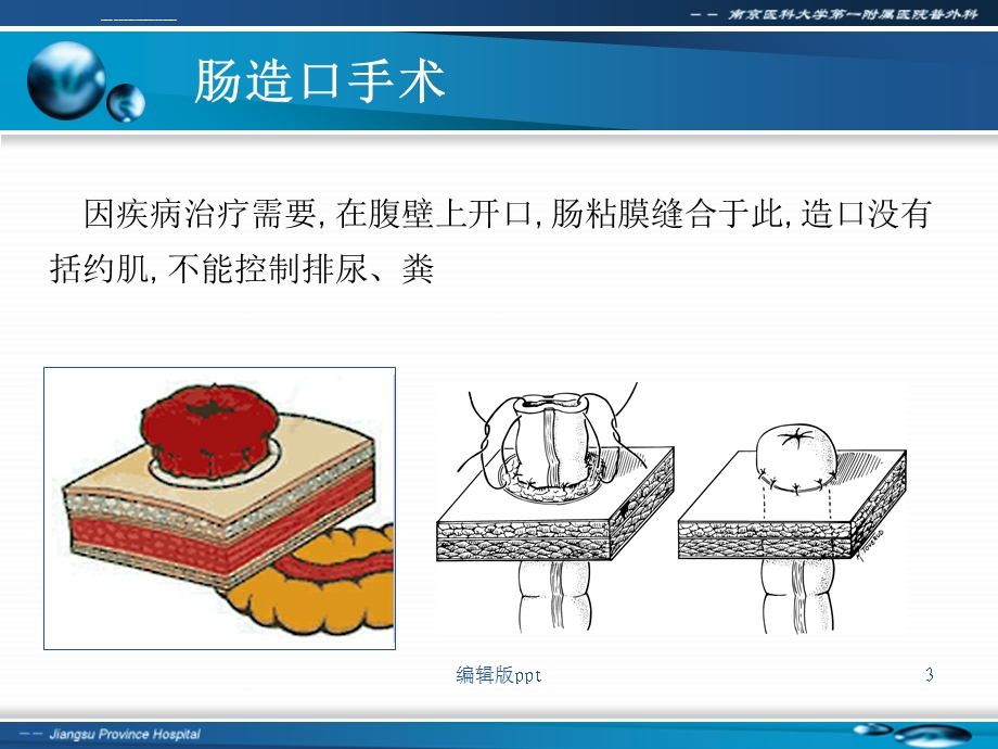 肠造口及其护理PPT课件.ppt_第3页