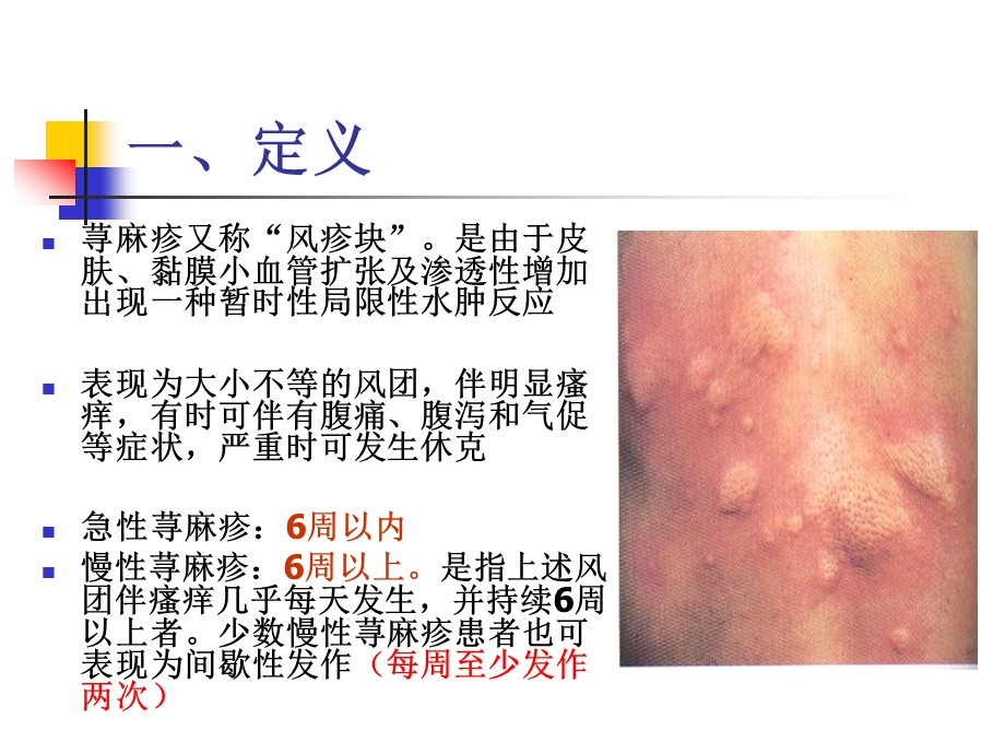 荨麻疹诊疗ppt课件.ppt_第3页