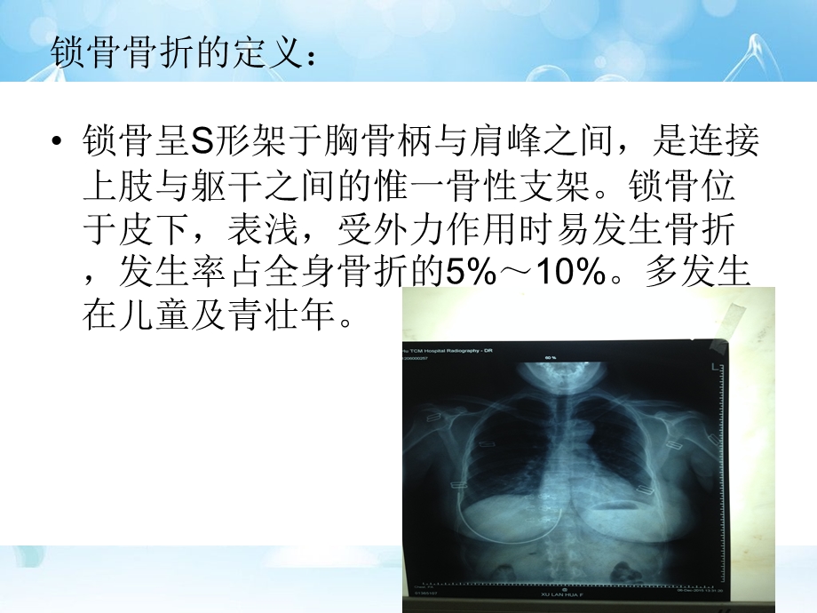 锁骨骨折护理查房ppt课件.pptx_第2页