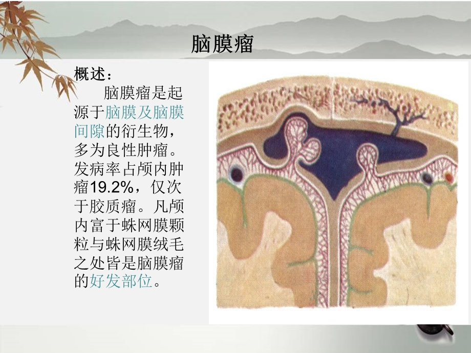 脑膜瘤护理查房ppt课件.ppt_第2页