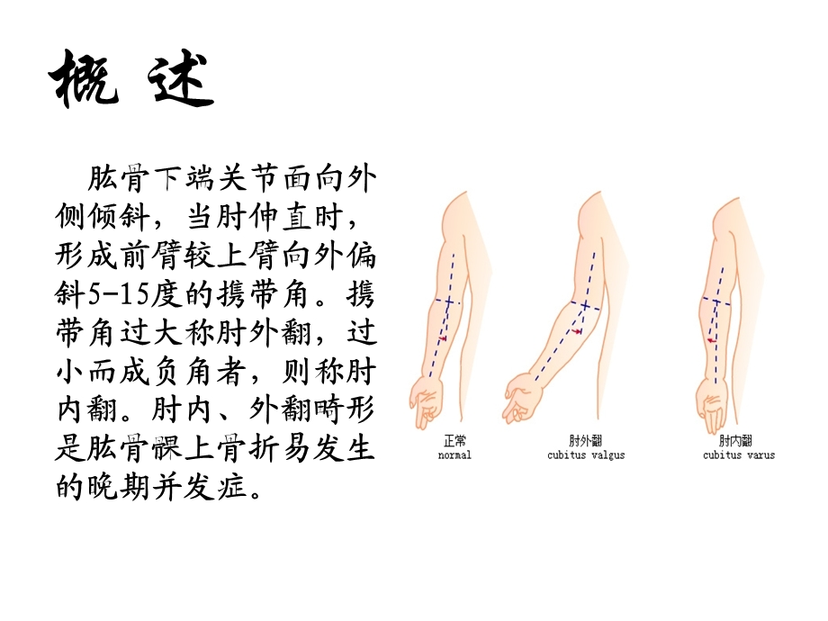 肱骨髁上骨折ppt课件.ppt_第3页