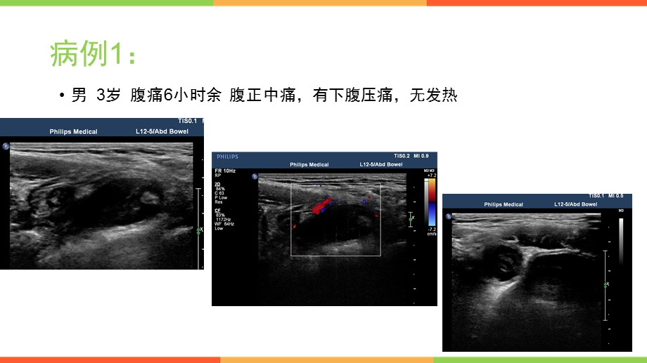 超声检查阑尾炎常见病例特征ppt课件.pptx_第2页