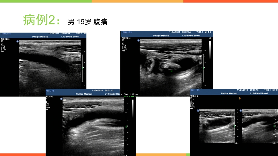 超声检查阑尾炎常见病例特征ppt课件.pptx_第3页