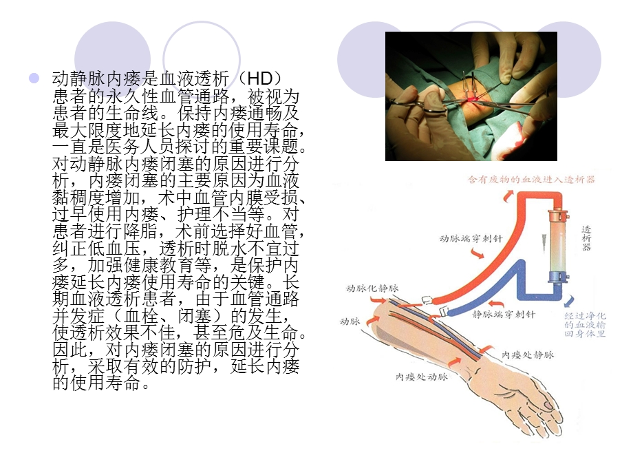 血液透析患者动静脉内瘘闭塞的原因与防护ppt课件.ppt_第2页