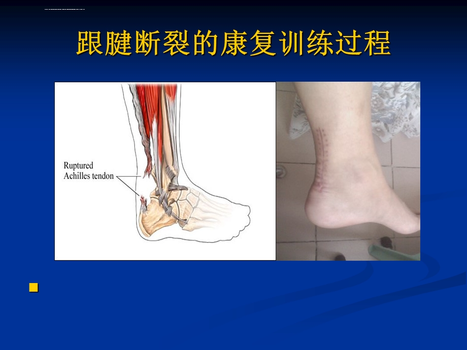 跟腱断裂的康复ppt课件.ppt_第1页